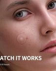 360Pcs Acne Pimple Zit Patches
