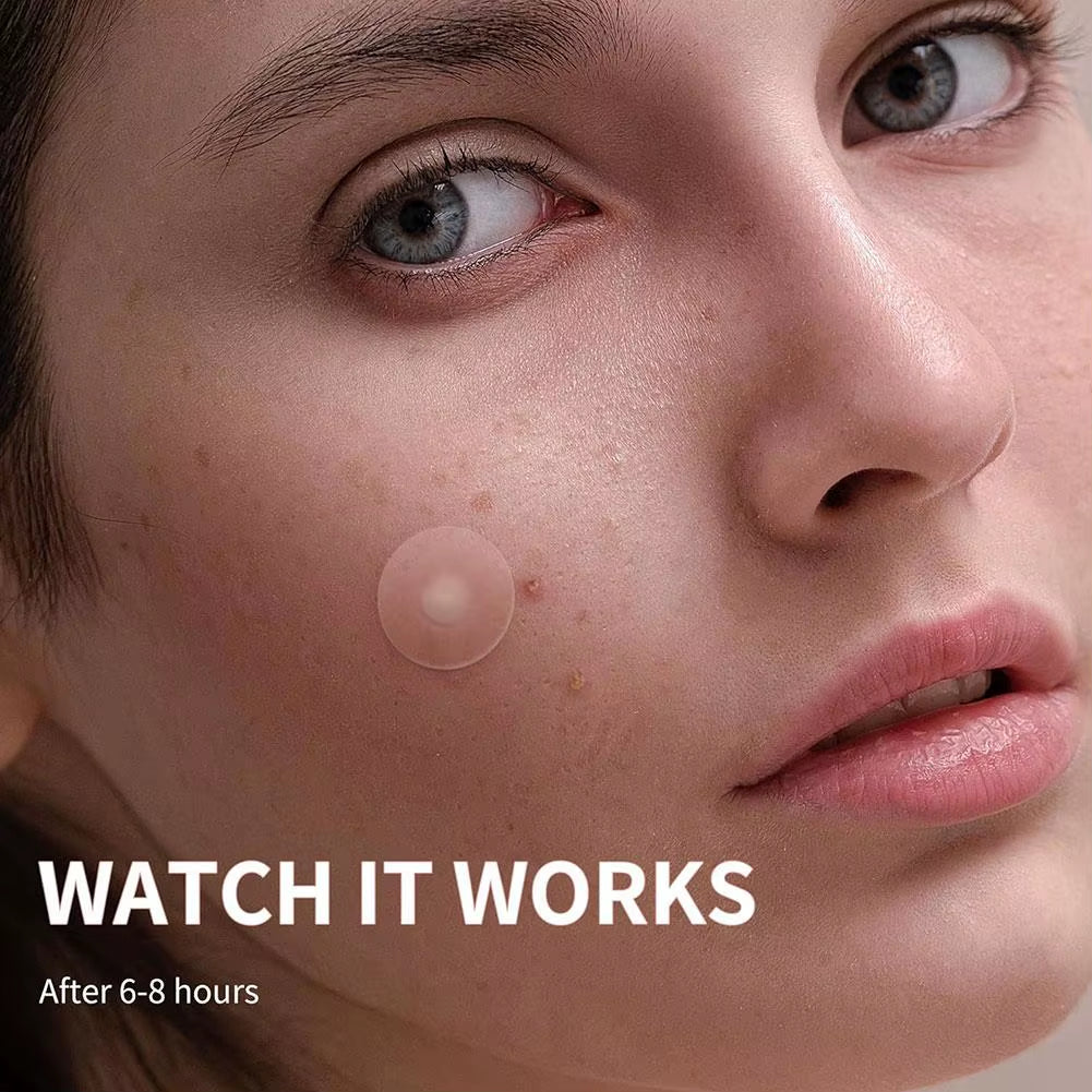 360Pcs Acne Pimple Zit Patches